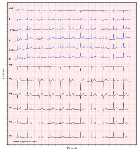 normal ecg sample